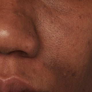Up close image of models cheek and nose after using Beekman 1802's Potato Peel Facial Peel for 2 weeks, showing shrunken pores and less oily skin.