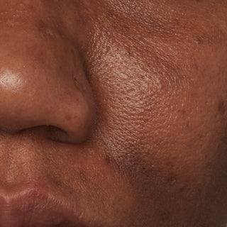 Up close image of models cheek and nose before using Beekman 1802's Potato Peel Facial Peel, showing big pores and oily skin. 