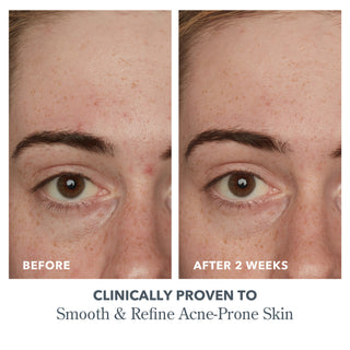 Before and after closeup side by side image of models forehead after using Beekman 1802's Potato Peel mask, revealing less acne after 2 weeks.