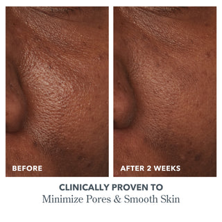 Before and after side by side image of right side of models cheek after using Beekman 1802's Potato Peel after 2 weeks, revealing smoother skin and bigger pores.
