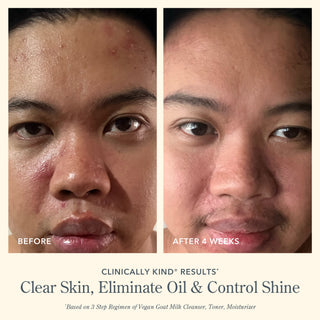 Up close side by side image of front of models face after using Beekman 1802's  step vegan goat milk regimen, showing oily red skin on the left, and clearer less shiny skin on the right after 4 weeks, with the words "clear skin, eliminate oil & control shine" at the bottom of the image. 