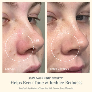 Up close before and after shot of side of model's face after using the 3 step vegan goat milk regimen, showing red inflamed skin on the left and clearer skin on the right with a circle showing where it helped, and the words "Helps even tone & reduce redness" at the bottom of the image.